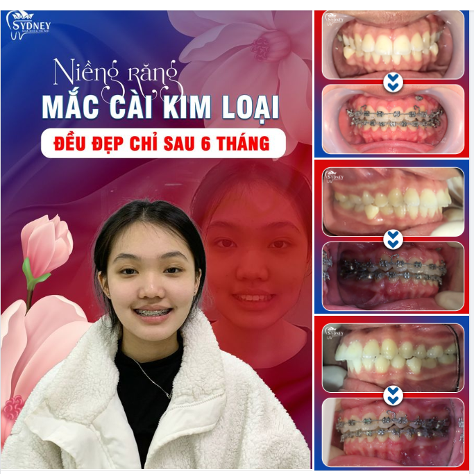 LỰA CHỌN NIỀNG RĂNG MẮC CÀI KIM LOẠI THAY ĐỔI HÀM RĂNG, NỤ CƯỜI