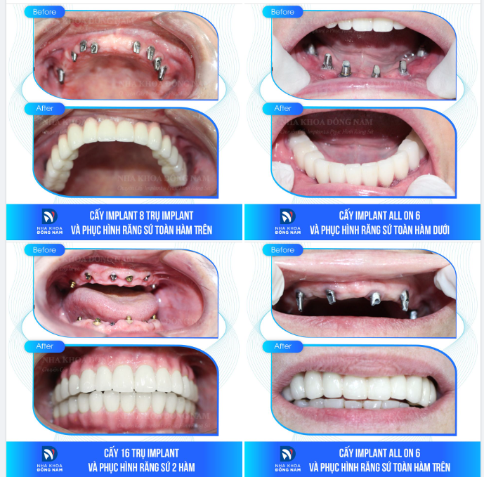 TỔNG HỢP: CÁC CASE CẤY GHÉP IMPLANT XUẤT SẮC NHẤT NĂM 2023