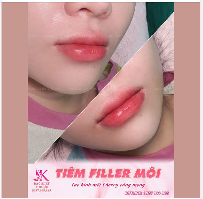 TIÊM FILLER MÔI CHERRY CĂNG MỌNG