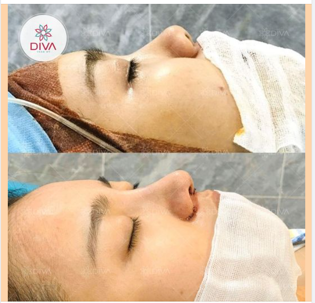 KẾT QUẢ THẨM MỸ SAU NÂNG MŨI SLINE SỤN TỰ THÂN