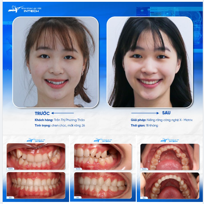 HÀNH TRÌNH TÌM LẠI NỤ CƯỜI TỰ TIN CHO THIẾU NỮ ĐÔI MƯƠI CÓ HÀM RĂNG “LỘN XỘN" !