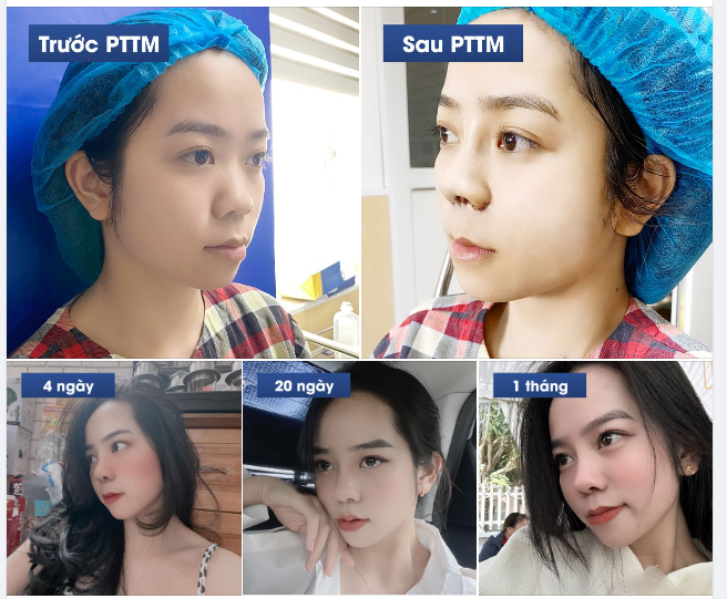 Dù sở hữu khuôn mặt ưa nhìn nhưng chiếc mũi thấp luôn khiến Trang tự ti, vì thế Trang luôn mong muốn được sở hữu dáng mũi cao giống các diễn viên Hàn Quốc.