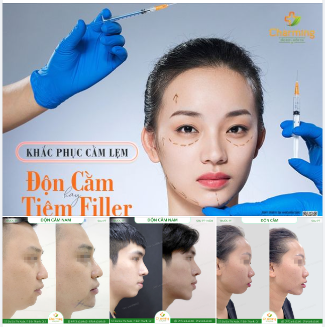 CẰM LẸM NÊN TIÊM FILLER HAY ĐỘN CẰM?
