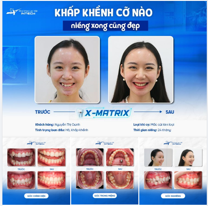 “KIỆT TÁC” NIỀNG RĂNG ĐƯỢC TẠO NÊN BỞI CÔNG NGHỆ X-MATRIX!