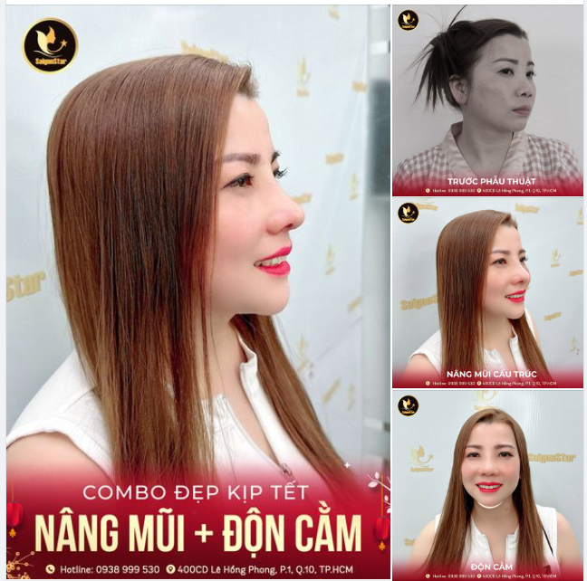 COMBO ĐẸP KỊP TẾT NÂNG MŨI CẤU TRÚC + ĐỘN CẰM