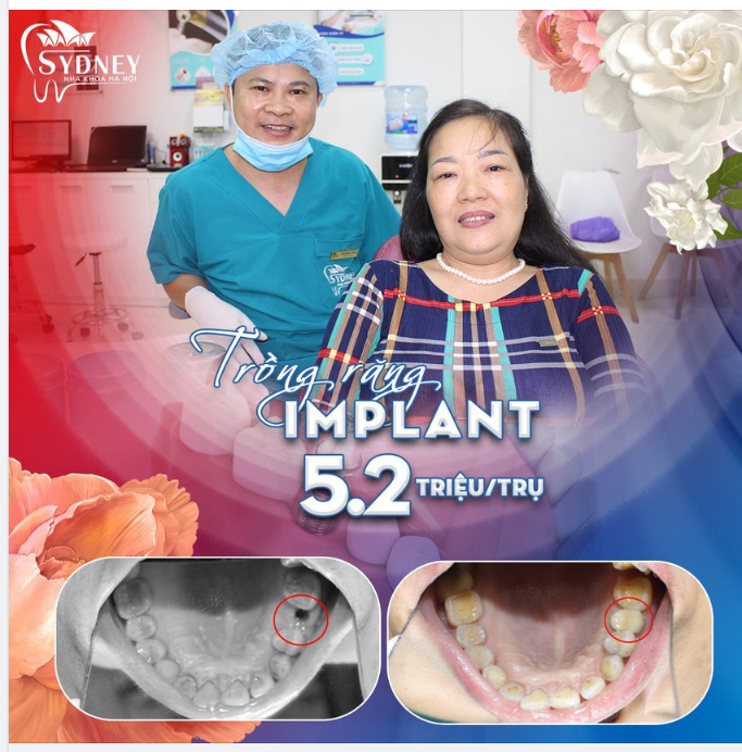 TRỒNG RĂNG ĐÓN TẾT – GẮN KẾT YÊU THƯƠNG