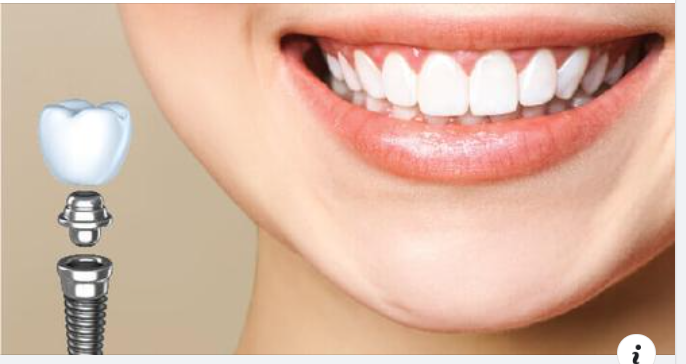 Cấy ghép Implant là gì? Có nên cấy Implant không?