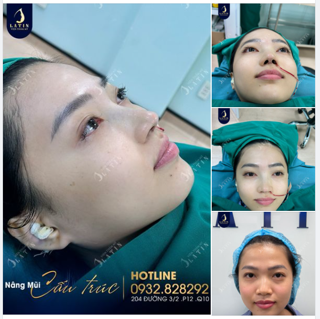 NÂNG MŨI ĐẸP NGAY - KỊP THỜI ĐÓN TẾT