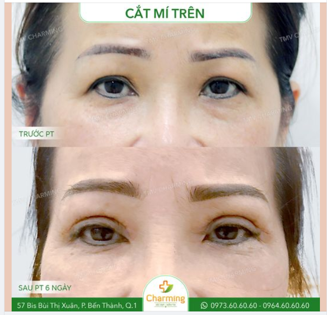 Da chùng là từ dùng chung cho tình trạng da mí mắt lão hóa và đổ xuống mí mắt khi tuổi tác của bạn đã đi quá tuổi bắt đầu lão hóa một thời gian.