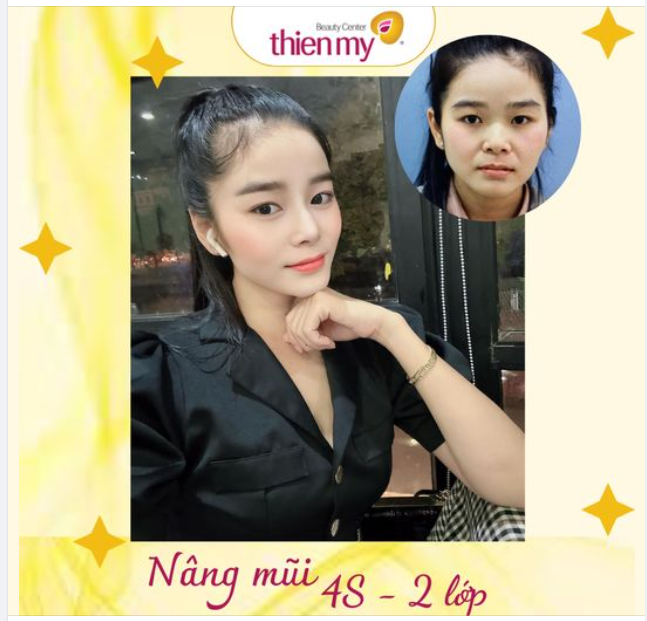 THAY DÁNG MŨI – LÀM MỚI CHÍNH MÌNH