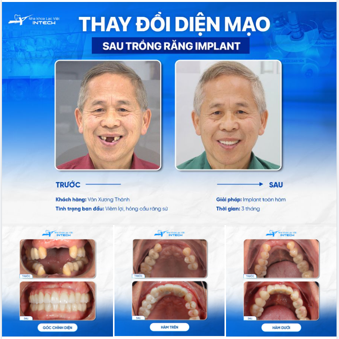 MẤT RĂNG LÂU NĂM, LẠC VIỆT INTECH TRẢ LẠI CUỘC SỐNG VUI KHỎE CHO VIỆT KIỀU NEW ZEALAND