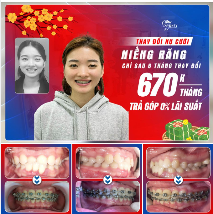 NIỀNG RĂNG KHẮC PHỤC CẮN NGƯỢC VỚI MẮC CÀI KIM LOẠI