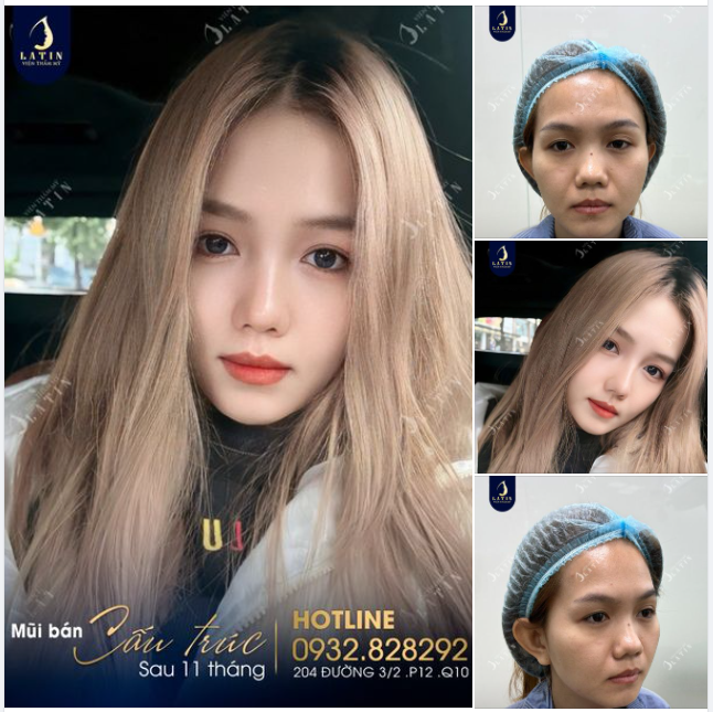 "Mũi đẹp lắm ạ, em làm mũi xong ai cũng khen..."