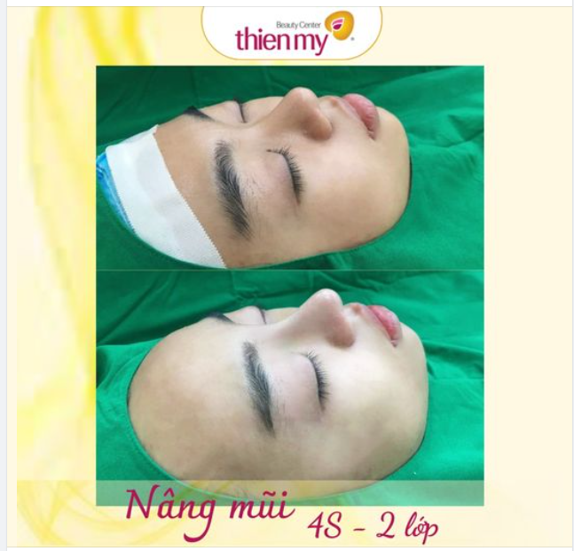 Các ưu điểm của phương pháp nâng mũi bọc sụn, dáng mũi độc quyền tại Thiện Mỹ: