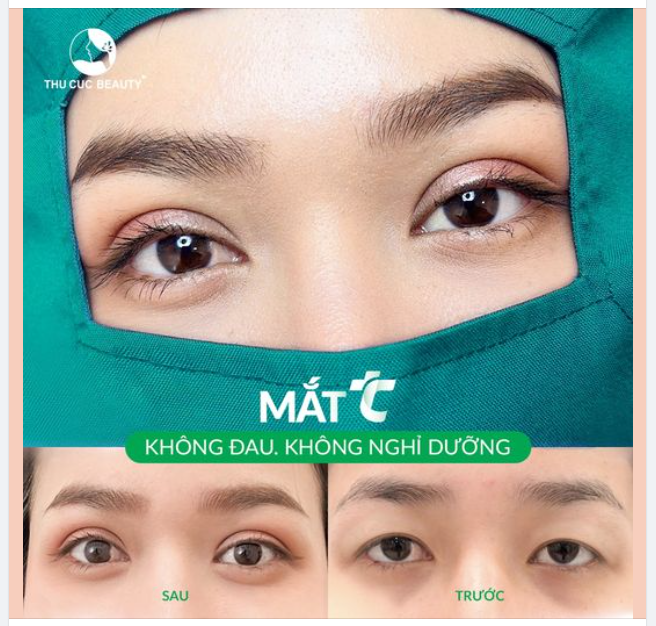 Khách hàng cắt mí Không đau, không nghỉ dưỡng