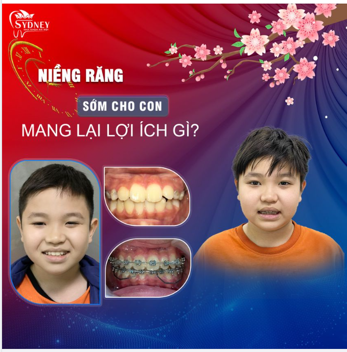 NIỀNG RĂNG SỚM CẢI THIỆN TƯƠNG LAI CHO TRẺ