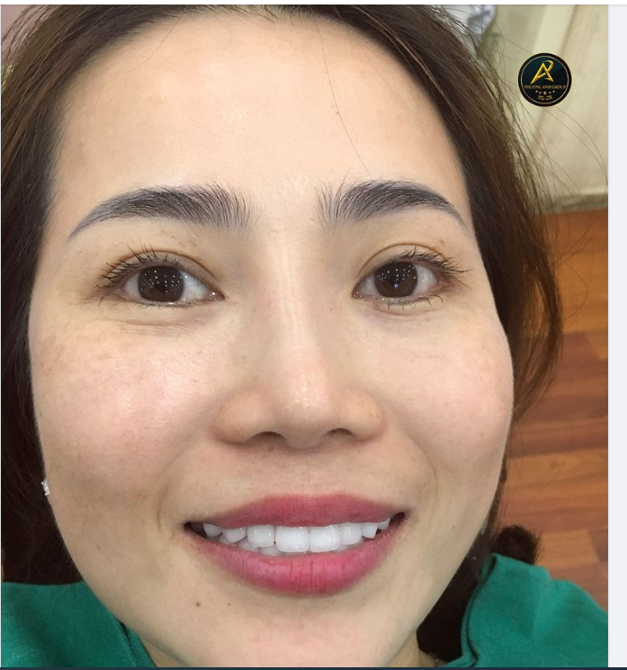 Bọc răng sứ hay dán sứ Veneer tốt – mỗi nơi tư vấn một kiểu
