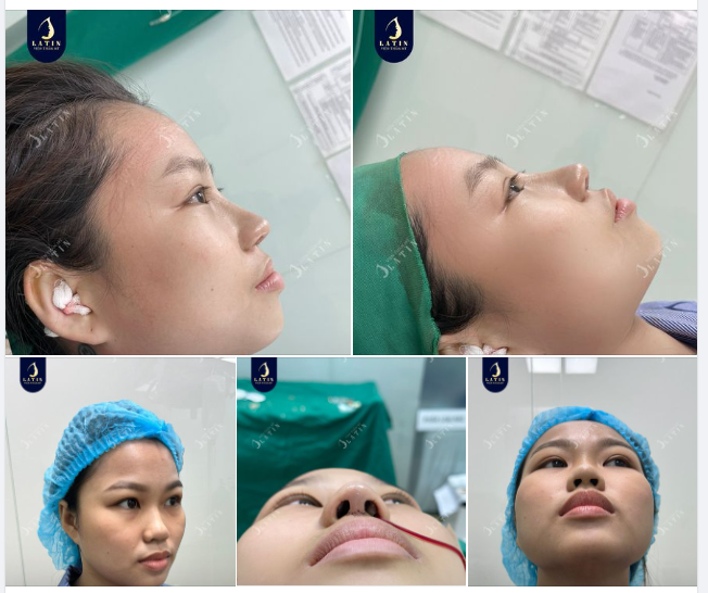 Cùng xem ngay kết quả nâng mũi cấu trúc sụn tai của em vừa hoàn thành nhé!