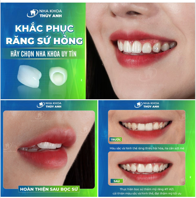 THẨM MỸ RĂNG SỨ - HÃY LỰA CHỌN NHA KHOA UY TÍN ĐỂ GỬI GẮM NỤ CƯỜI