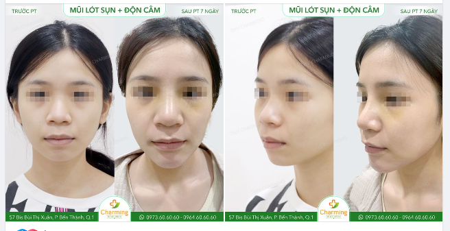Mũi to đã khiến mặt tròn, lại thêm cằm ngắn thì càng tròn hơn .