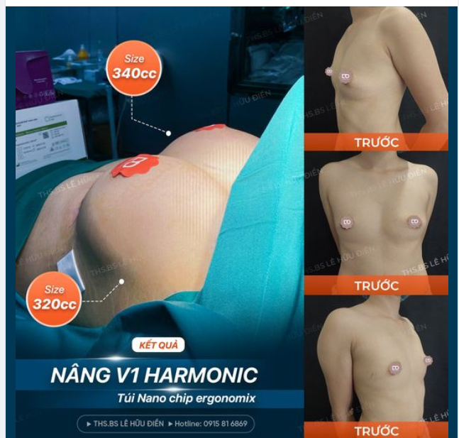 SAU 60 PHÚT NÂNG NGỰC SẼ THAY ĐỔI NHƯ THẾ NÀO?