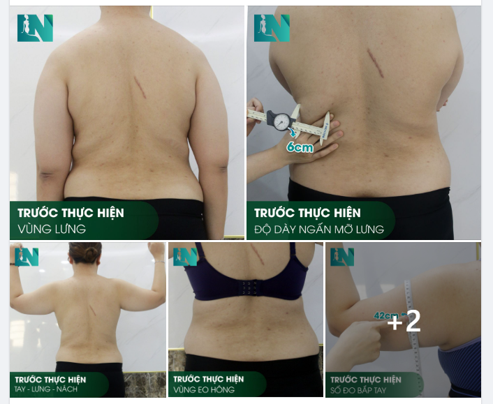 HÌNH ẢNH TRƯỚC KHI THỰC HIỆN HÚT MỠ TẠO DÁNG TAY - LƯNG - NÁCH VÀ EO - HÔNG CHO CHỊ KHÁCH HÀNG SINH NĂM 1992