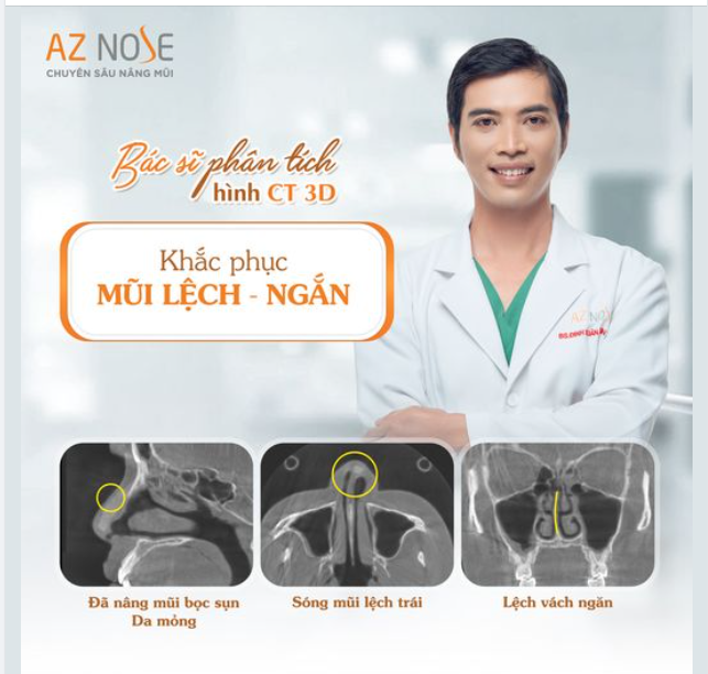 Xử lý mũi lệch - ng.ắn cho sinh viên 2K