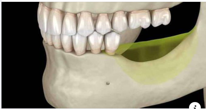 Người bị mất răng có niềng răng được không
