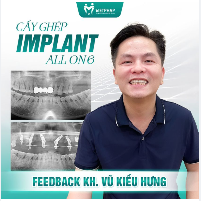 FEEDBACK KHÁCH HÀNG SAU KHI CẤY IMPLANT TẠI NHA KHOA VIỆT PHÁP