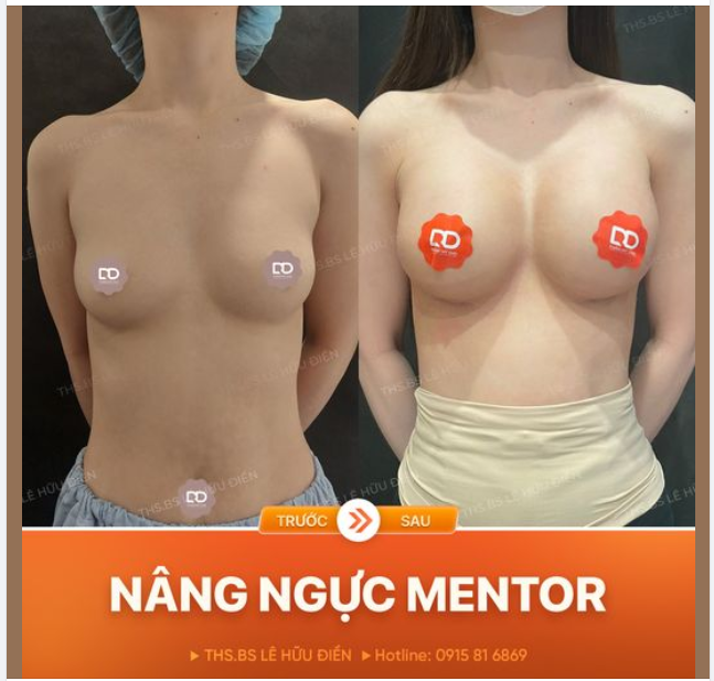 NÂNG NGỰC HARMONIC - Thay đổi ngoạn mục vóc dáng