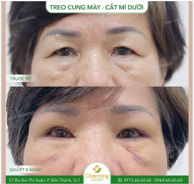 Nhìn đôi mắt này, nhiều người sẽ đổ thừa mọi điểm xấu của đôi mắt cho mí trên: do mí trên chùng, mí trên lão hoá,… nhưng nguyên nhân thật sự không phải như thế.