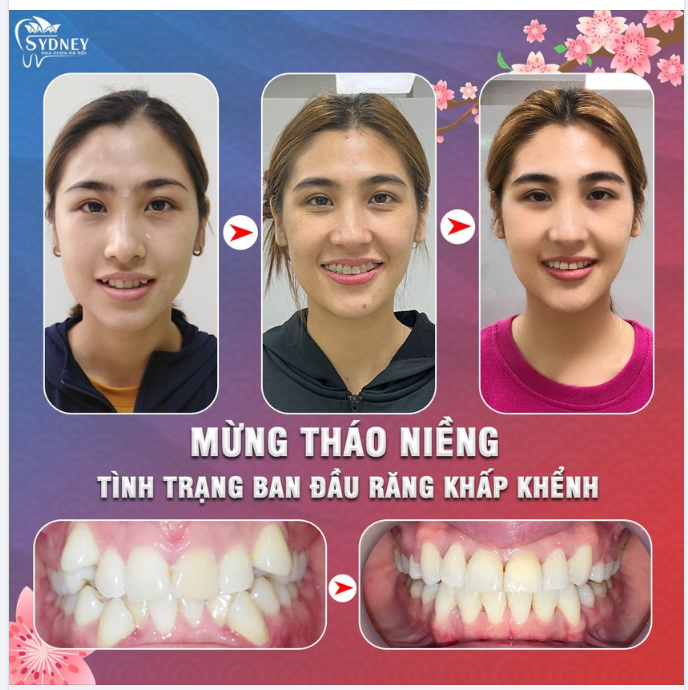 RẠNG RỠ NỤ CƯỜI TƯƠI ĐÓN TẾT CÙNG NHA KHOA HÀ NỘI SYDNEY!