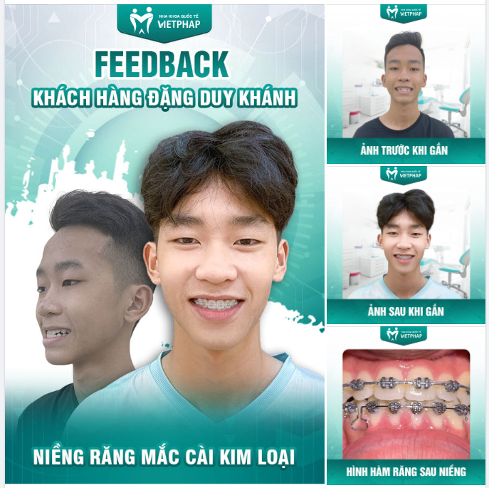 DỨT ĐIỂM TÌNH TRẠNG MÓM, THÊM MỘT NỤ CƯỜI THÀNH CÔNG CHO KHÁCH HÀNG DUY KHÁNH NHỜ NIỀNG RĂNG