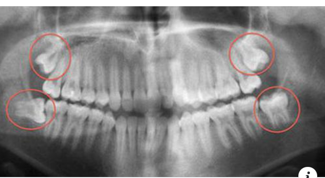 NHỮNG BIẾN CHỨNG DO RĂNG KHÔN MỌC LỆCH VÀ CÁCH XỬ TRÍ