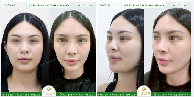 Chiếc mũi cũ của bạn khách này nhìn từ phía trước thì nhỏ và ngắn hơn so với tổng thể khuôn mặt.