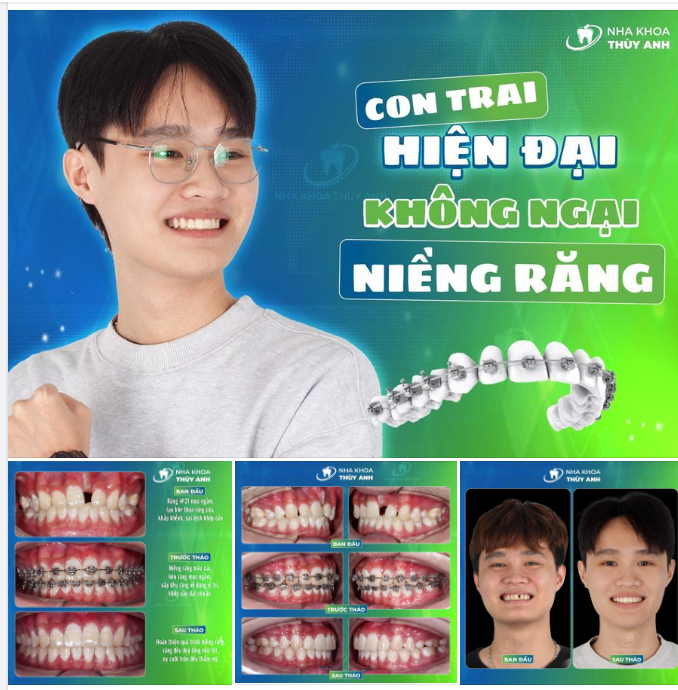 GENZ HIỆN ĐẠI, KHÔNG NGẠI NIỀNG RĂNG TRƯỚC TẾT