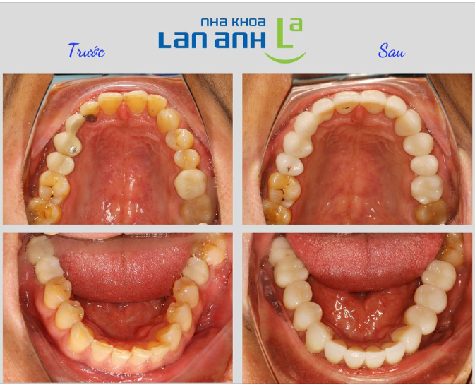 THẨM MỸ RĂNG SỨ - RĂNG ĐẸP MÊ LY, VẠN SỰ NHƯ Ý