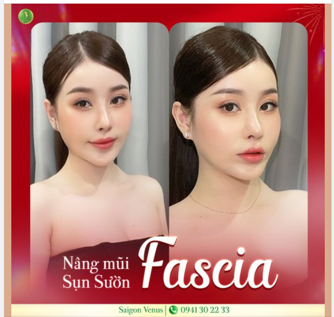 MŨI ĐẸP KỊP TẾT - SALE HẾT THẢ GA