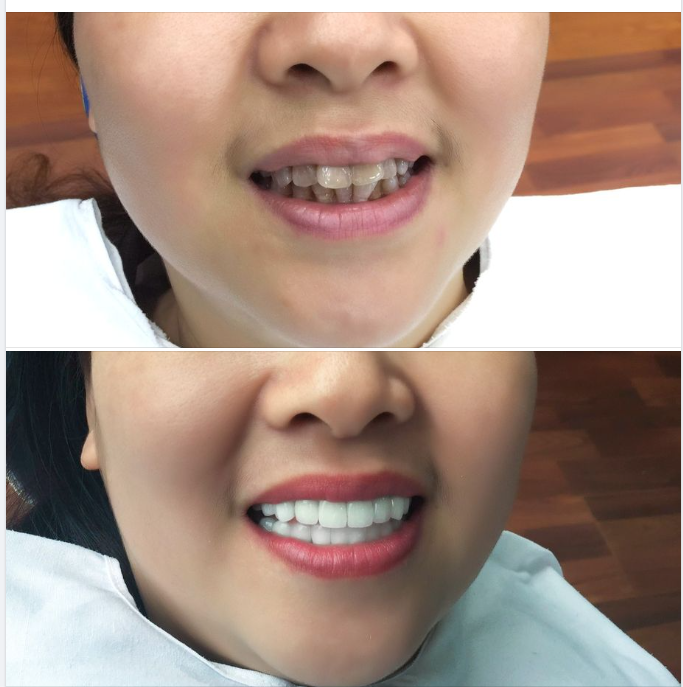 Răng sứ kim loại có mấy loại