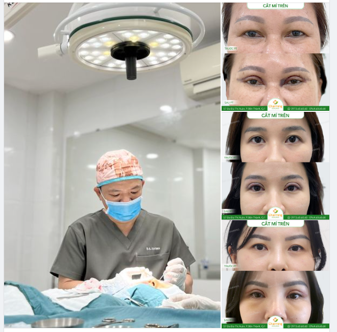 CẮT MÍ TRÊN - GIẢI PHÁP NÂNG CẤP TUYỆT VỜI CHO ĐÔI MẮT