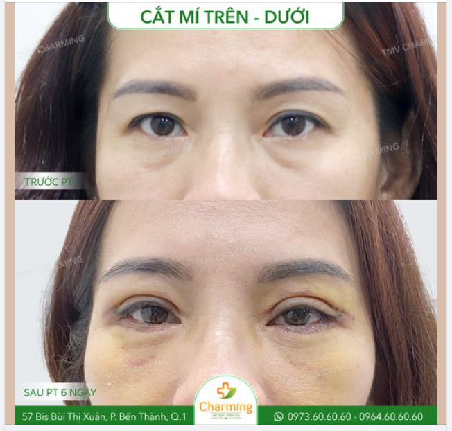 Bạn có bao giờ để ý rằng cắt mí có mức độ trẻ hóa rất cao so với các phẫu thuật khác không?