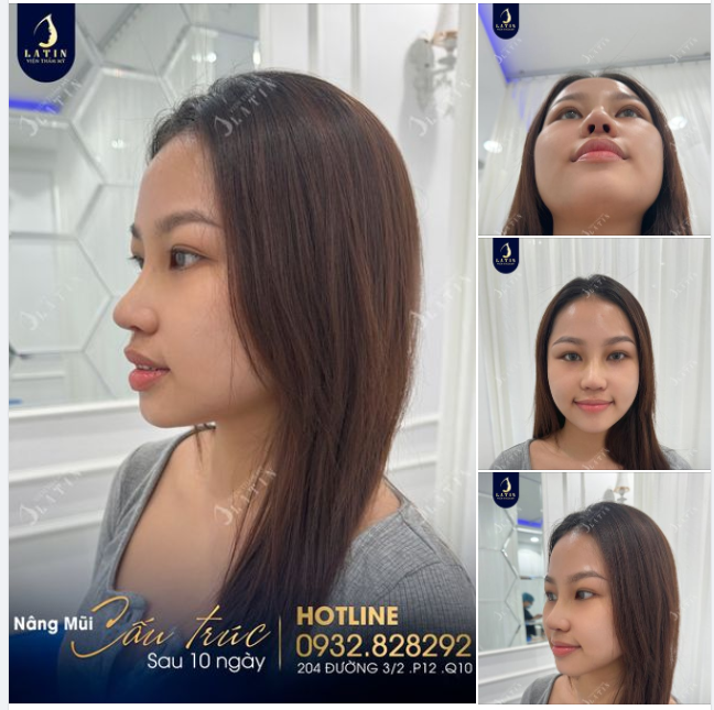 Mũi cấu trúc 10 ngày lên dáng đẹp như mong ước cho em gái.