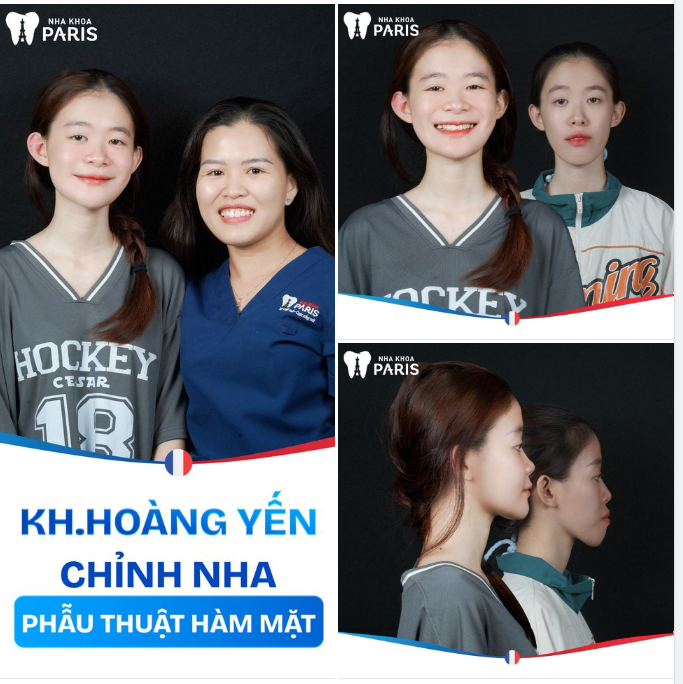 Không phải mất 1-3 năm để chờ đợi, đây là thành quả chỉ sau hơn 1 tháng khi lựa chọn phẫu thuật hàm mặt tại Nha khoa Paris