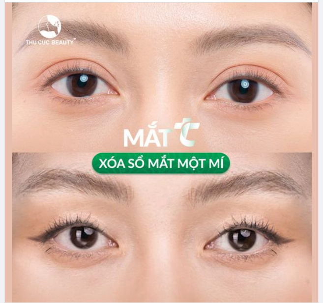 Thu Cúc xóa sổ mắt hai hí cho khách hàng