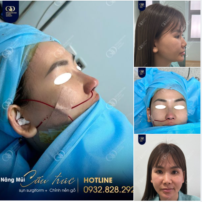 Nâng mũi xong là kịp đẹp đón Tết luôn