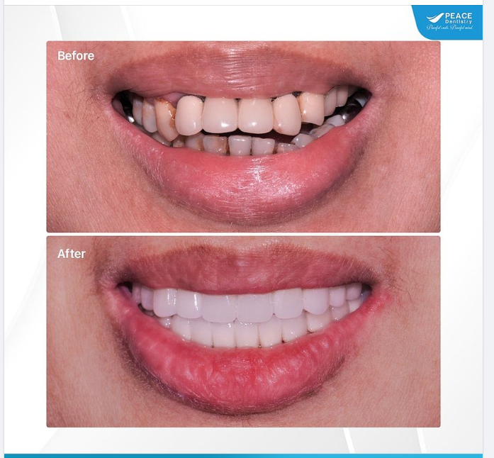 Ca lâm sàng với 9 đơn vị implant giúp khôi phục trọn vẹn chắc năng ăn nhai và nâng cao thẩm mỹ nụ cười cho Cô khách hàng 60 tuổi