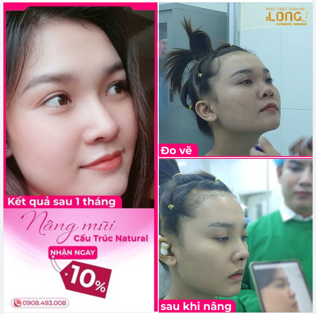 NÂNG MŨI SAU BAO LÂU THÌ ĐẸP ?