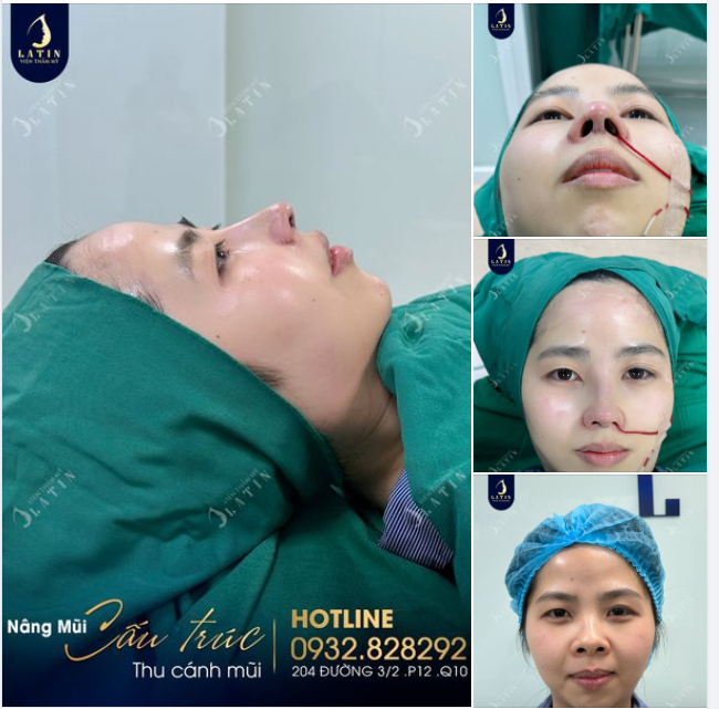 Về Việt Nam ăn Tết, em gái kịp thời có mũi đẹp