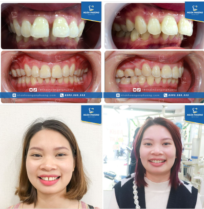 Răng khó thế nào mà Hồng Nhung phải đeo mắc cài những gần 3 năm? Hồng Nhung là một ca niềng răng đặc biệt với rất nhiều vấn đề