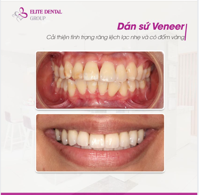 Dán sứ Veneer: Cải thiện tình trạng răng không đều nhẹ và có nhiều đốm vàng